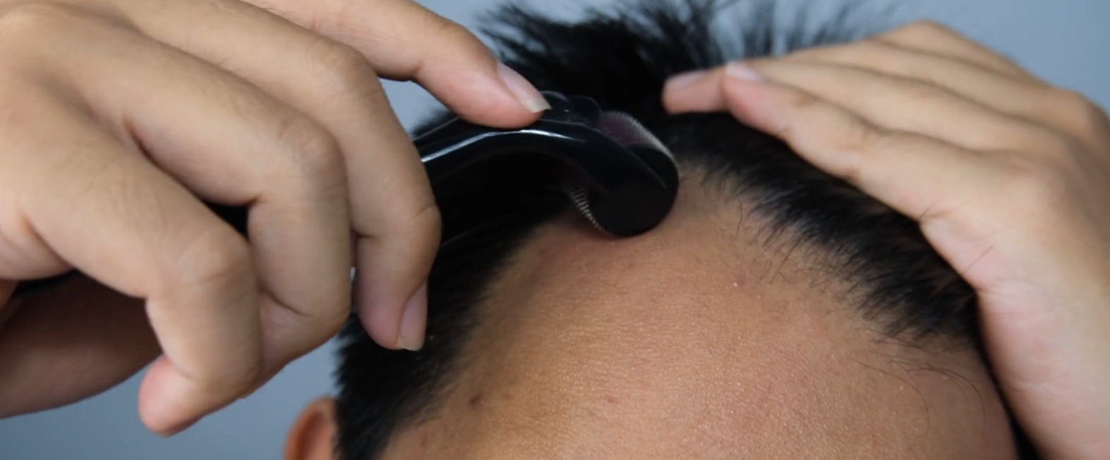 How to Use a Derma Roller for Hair Loss