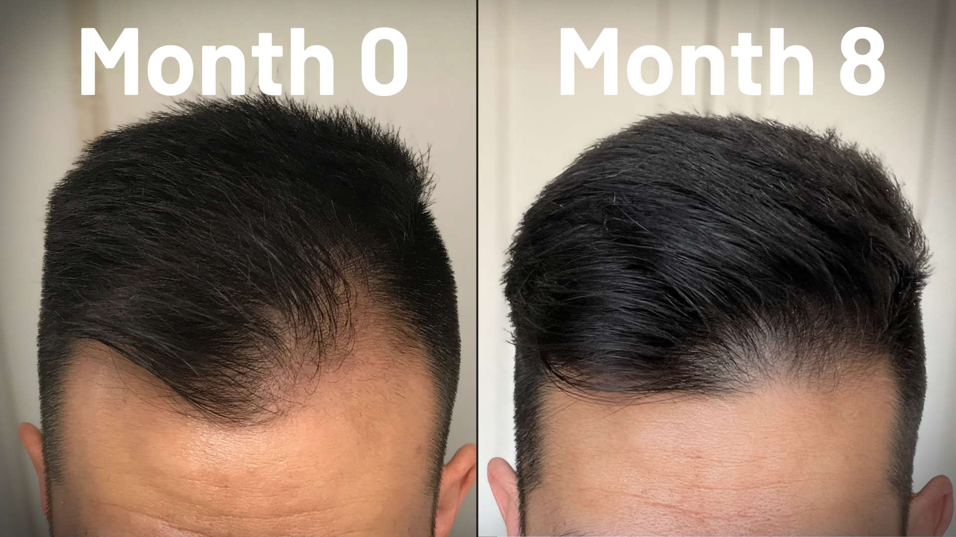 Microneedling for Hairline Restoration: What to Expect