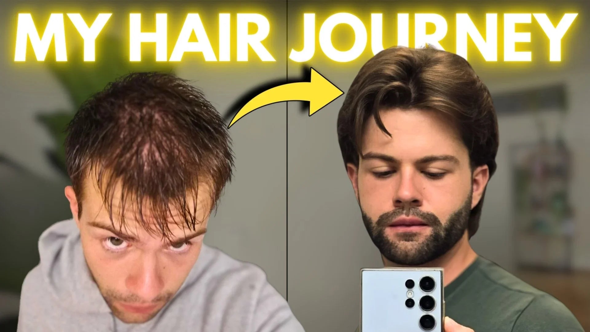 My Finasteride Hair Regrowth Success Story (Month-by-Month Results)