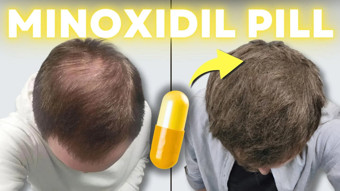Oral Minoxidil - The TRUTH to Unlocking Your BEST Hair Growth
