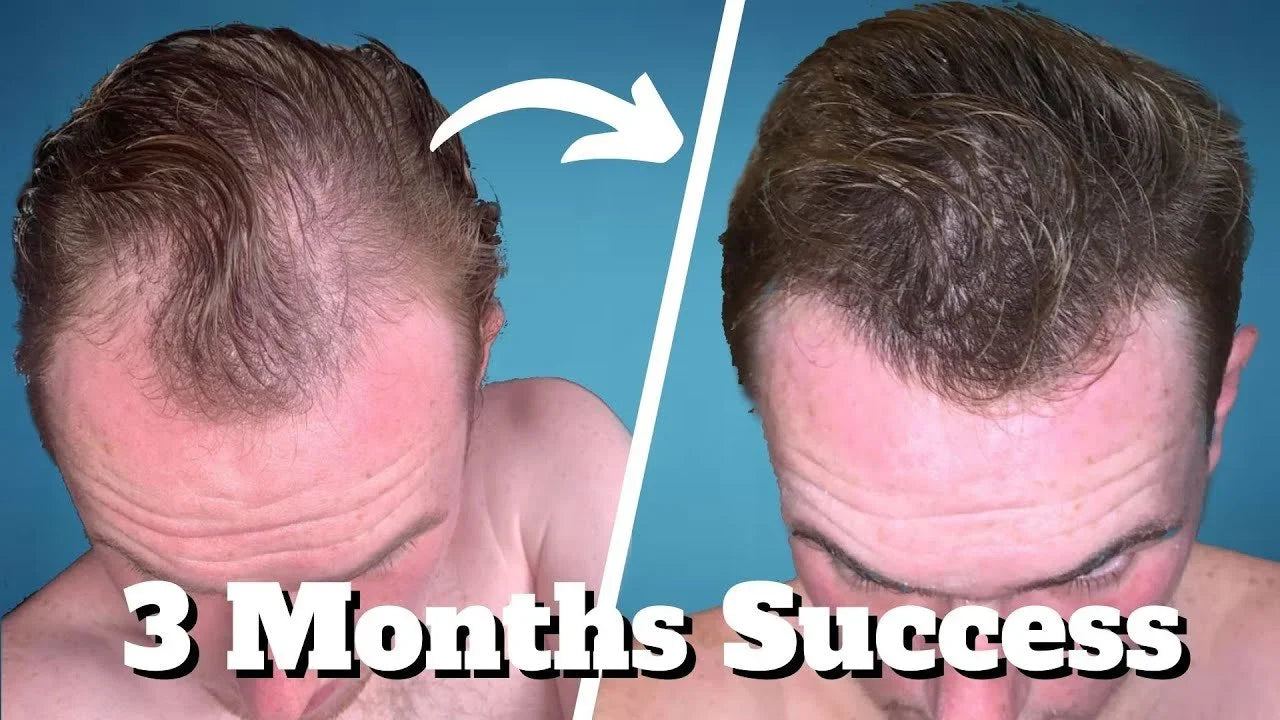 TOPICAL FINASTERIDE: The GREATEST Underrated Hair Remedy?