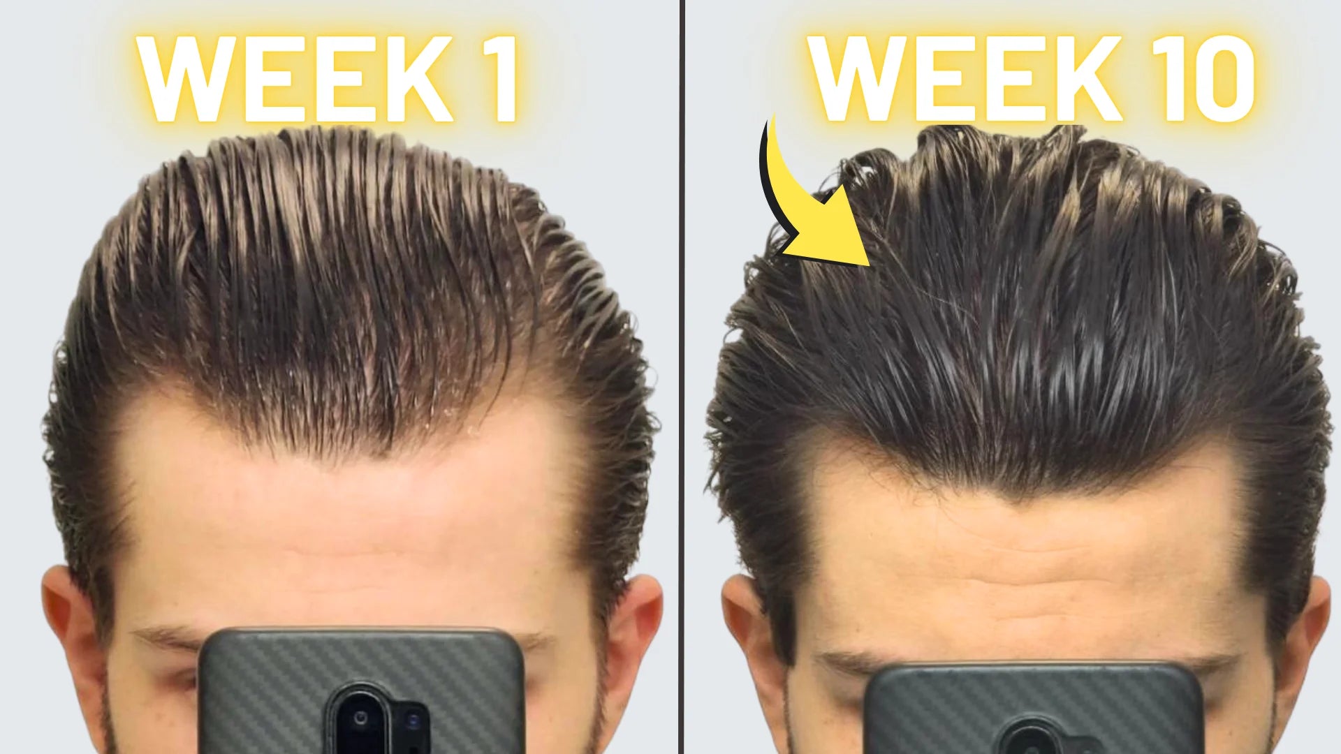 My INSANE 2.5 Months on FINASTERIDE, MINOXIDIL and DERMAROLLER