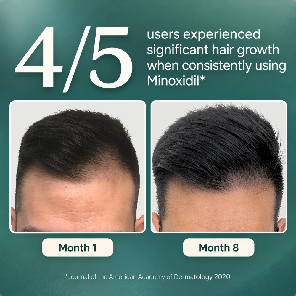 Follicly® Minoxidil 5% Topical Solution – Extra Strength Hair Regrowth Treatment, 2 FL OZ (60 mL)